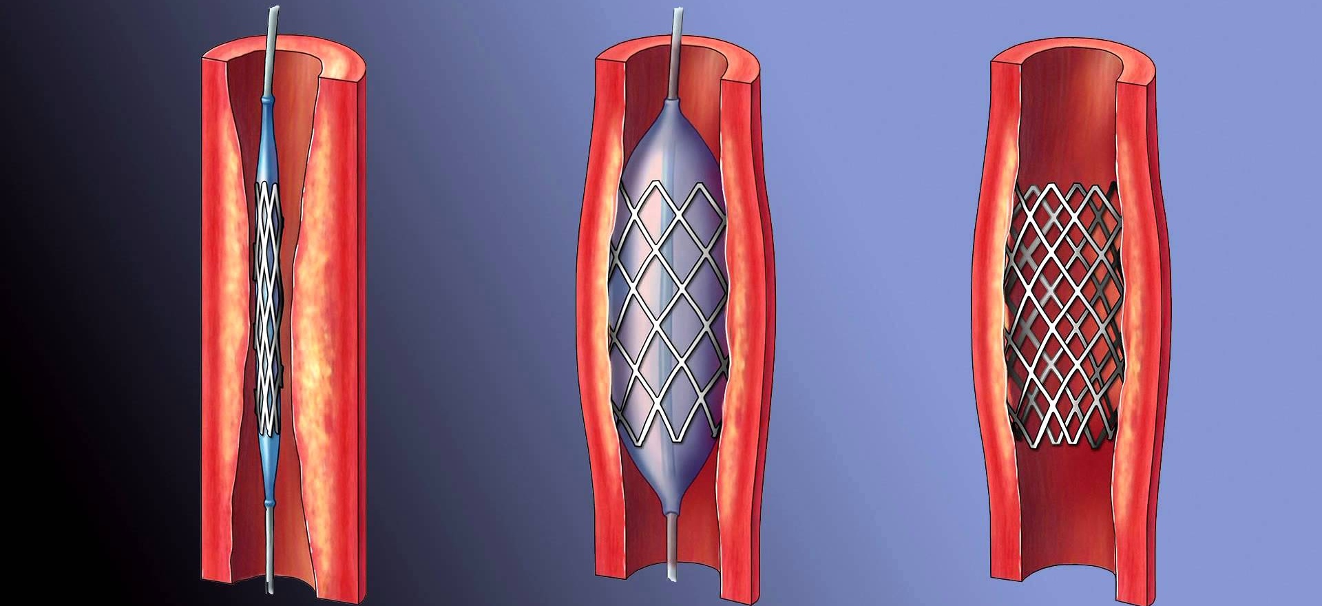 Coronary Angioplasty and Stenting